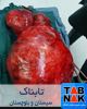 خارج کردن توده شش کیلویی از بدن بیمار در زاهدان
